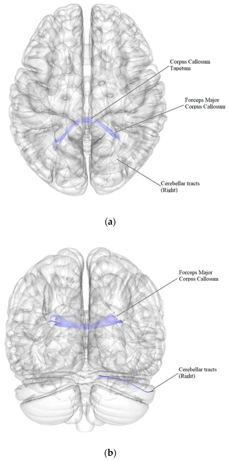 Microstructural Properties of Brain White Matter Tracts in Breast Cancer Survivors: A Diffusion Tensor Imaging Study.