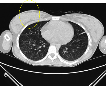 Peritoneal and Pulmonary Tuberculosis in a Postpartum Female with Elevated Cancer Antigen 125 and Ascites.