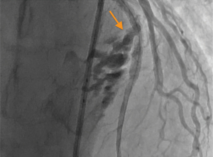 The successful management of type III coronary perforation.