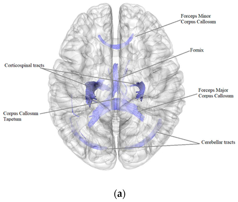 Microstructural Properties of Brain White Matter Tracts in Breast Cancer Survivors: A Diffusion Tensor Imaging Study.