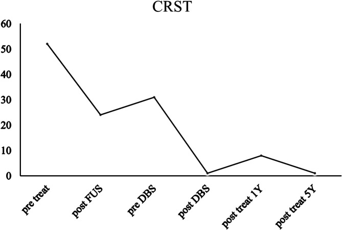 Hybrid surgery of ventral intermediate nucleus thalamotomy using magnetic resonance-guided focus ultrasound and modulation by deep brain stimulation controls bilateral essential tremor.