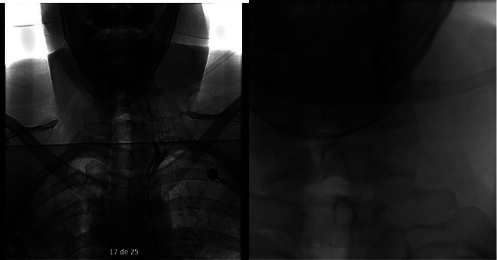 Ischemic Stroke Secondary to a Stab Wound to the Neck in a Young Adult.