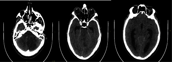 Ischemic Stroke Secondary to a Stab Wound to the Neck in a Young Adult.