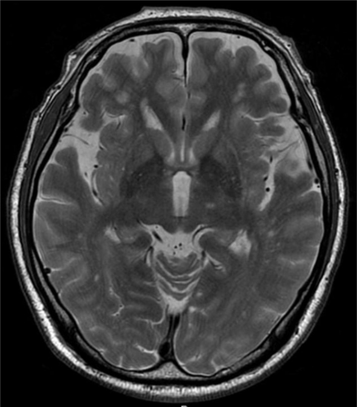 Hybrid surgery of ventral intermediate nucleus thalamotomy using magnetic resonance-guided focus ultrasound and modulation by deep brain stimulation controls bilateral essential tremor.