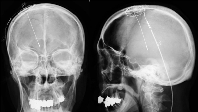 Hybrid surgery of ventral intermediate nucleus thalamotomy using magnetic resonance-guided focus ultrasound and modulation by deep brain stimulation controls bilateral essential tremor.