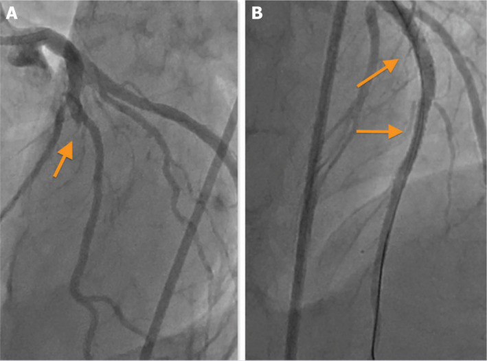 The successful management of type III coronary perforation.