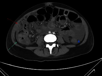 Peritoneal and Pulmonary Tuberculosis in a Postpartum Female with Elevated Cancer Antigen 125 and Ascites.