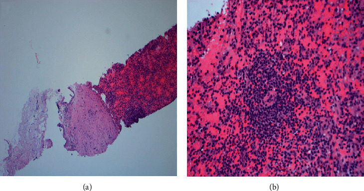 Calcification in Thoracic Splenosis.