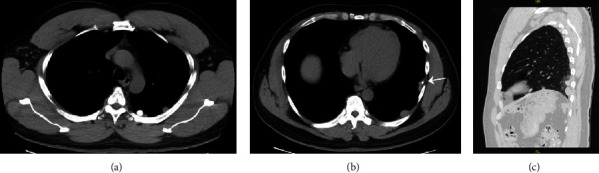 Calcification in Thoracic Splenosis.