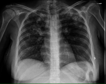 Peritoneal and Pulmonary Tuberculosis in a Postpartum Female with Elevated Cancer Antigen 125 and Ascites.