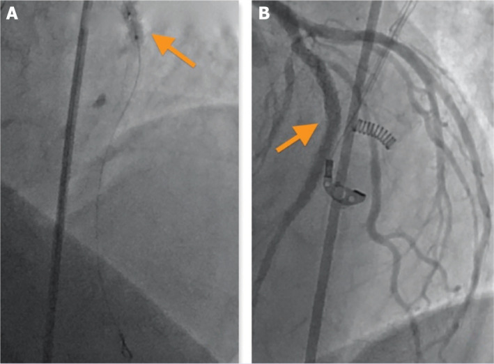 The successful management of type III coronary perforation.