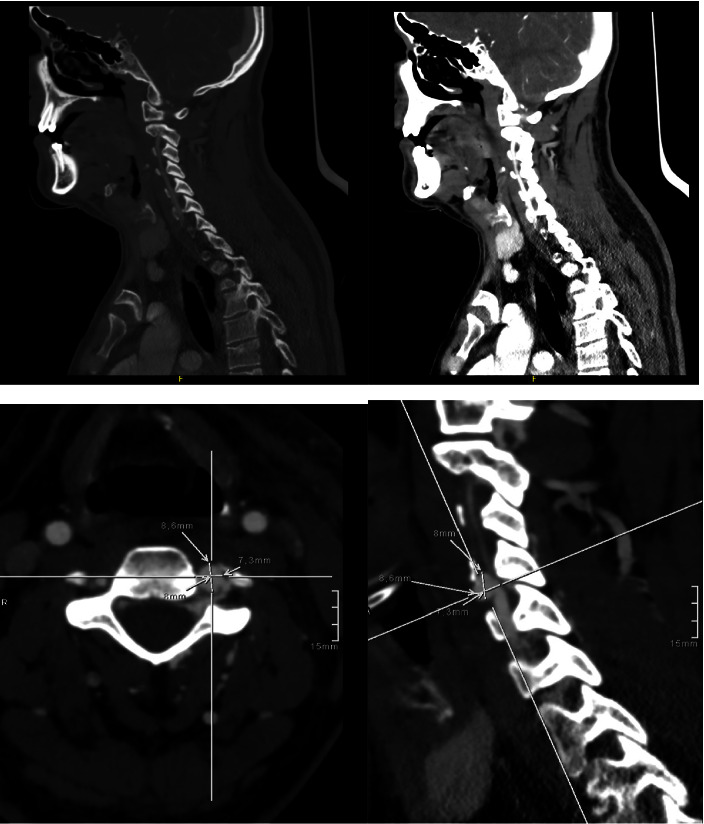 Ischemic Stroke Secondary to a Stab Wound to the Neck in a Young Adult.