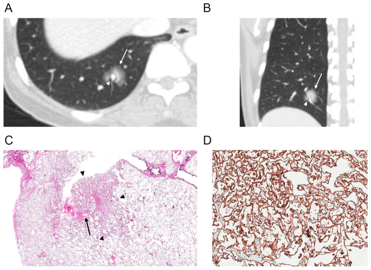 Solitary Pulmonary Capillary Hemangioma: CT and PET-CT Features with Clinicopathologic Correlation.