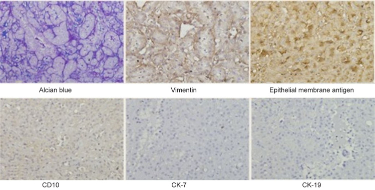 Mucinous Tubular and Spindle Cell Renal Cell Carcinoma (MTSC-RCC) with an Unusual Presentation in a Child.