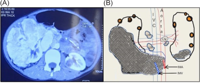 Mucinous Tubular and Spindle Cell Renal Cell Carcinoma (MTSC-RCC) with an Unusual Presentation in a Child.