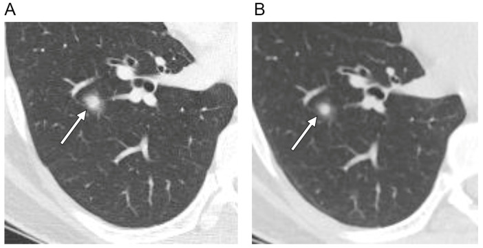 Solitary Pulmonary Capillary Hemangioma: CT and PET-CT Features with Clinicopathologic Correlation.