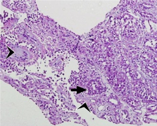 Mucinous Tubular and Spindle Cell Renal Cell Carcinoma (MTSC-RCC) with an Unusual Presentation in a Child.