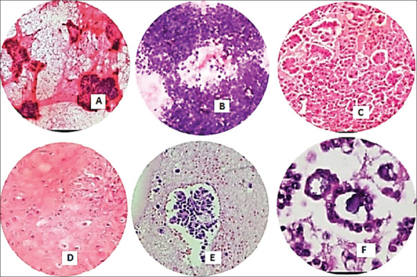 Diagnosis of Pleural Fluid Effusions by Cell Block and Pleural Biopsy - A Comparative Study.