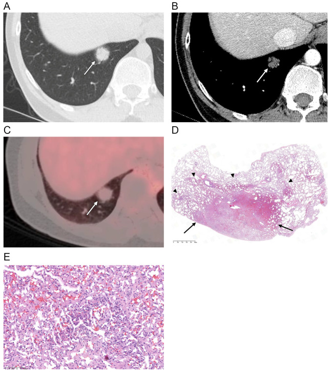 Solitary Pulmonary Capillary Hemangioma: CT and PET-CT Features with Clinicopathologic Correlation.