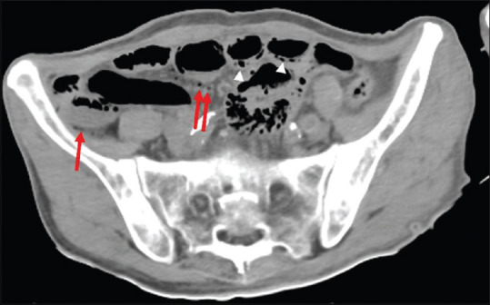 A Case of Fulminant Pneumatosis Intestinalis Resembling Tumor Lysis Syndrome.