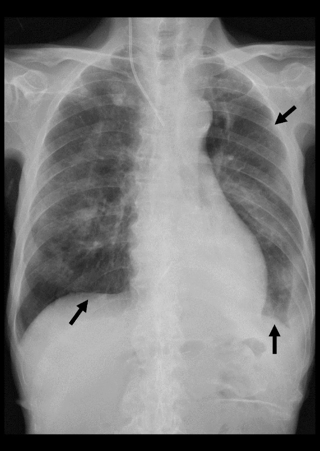 A Mycobacterium tuberculosis-Infected Patient Who Could Not Tolerate Oral Intake Successfully Treated Using an Intravenous Tedizolid-Containing Regimen.