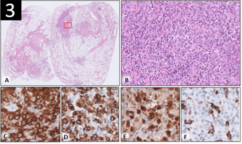 Insidious Onset of Pulmonary Langerhans Cell Histiocytosis During Oncological Follow-Up.