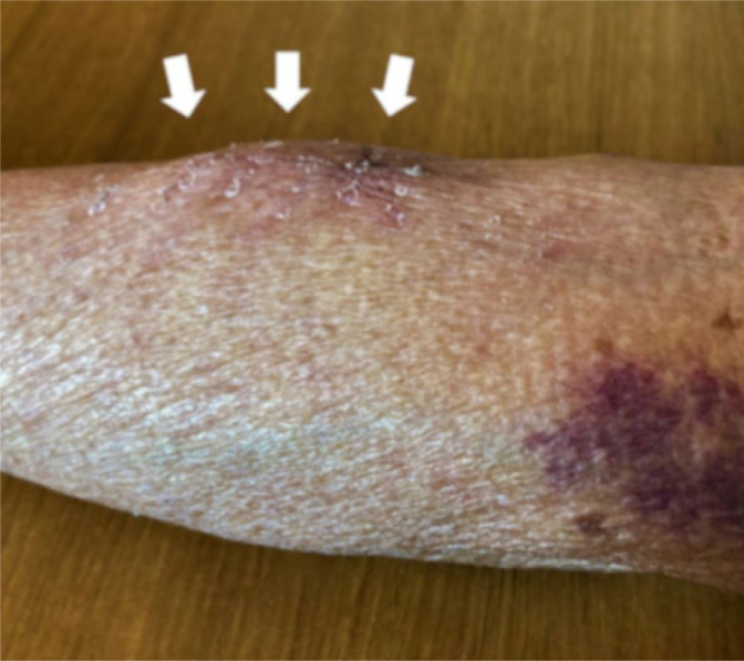 Seroma as a Rare Complication of Autologous Arteriovenous Fistula Creation in the Forearm of a Hemodialysis Patient: A Case Report.