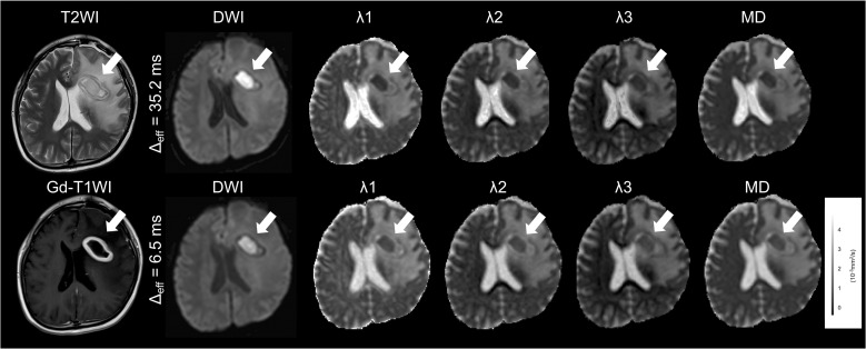 Time-dependent Diffusion in Brain Abscesses Investigated with Oscillating-gradient Spin-echo.