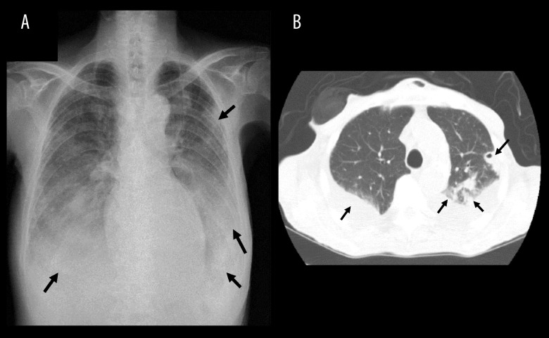 A Mycobacterium tuberculosis-Infected Patient Who Could Not Tolerate Oral Intake Successfully Treated Using an Intravenous Tedizolid-Containing Regimen.