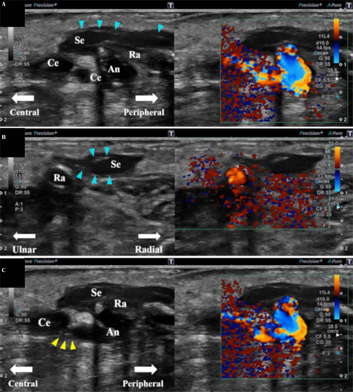 Seroma as a Rare Complication of Autologous Arteriovenous Fistula Creation in the Forearm of a Hemodialysis Patient: A Case Report.