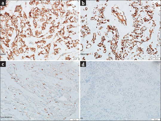 Sclerosing Perivascular Epithelioid Cell Tumor of the Uterus: A Rare Entity Posing Diagnostic Challenge.