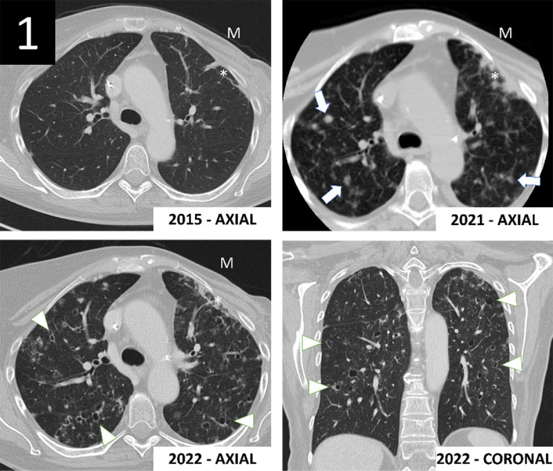 Insidious Onset of Pulmonary Langerhans Cell Histiocytosis During Oncological Follow-Up.