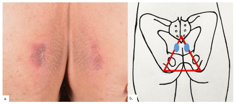 Reactive Epidermal Hyperplasia and Angiogenesis of the Rear (REAR): A Proposed Unifying Name for Senile Gluteal Dermatosis and Prurigiform Angiomatosis.