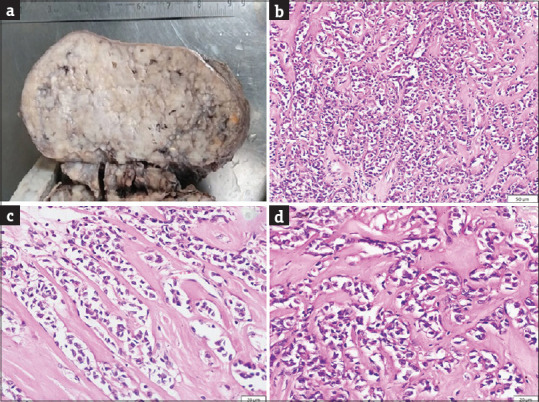 Sclerosing Perivascular Epithelioid Cell Tumor of the Uterus: A Rare Entity Posing Diagnostic Challenge.