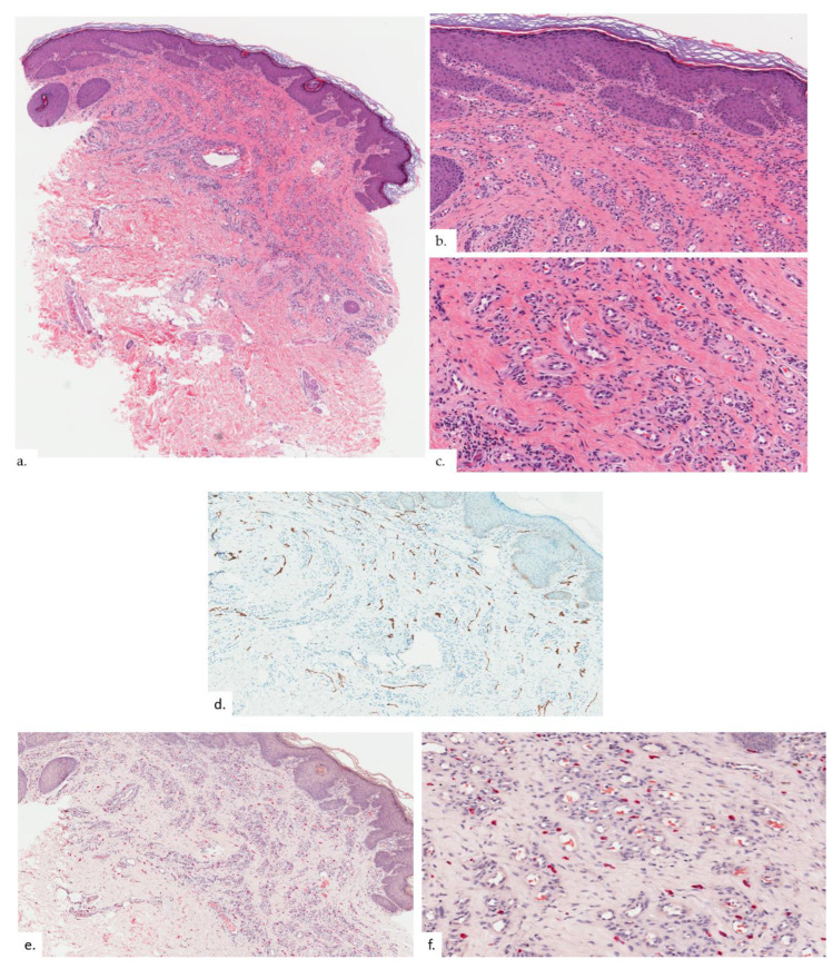 Reactive Epidermal Hyperplasia and Angiogenesis of the Rear (REAR): A Proposed Unifying Name for Senile Gluteal Dermatosis and Prurigiform Angiomatosis.
