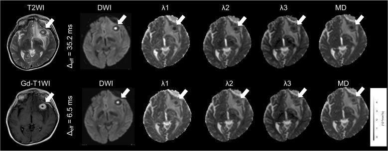 Time-dependent Diffusion in Brain Abscesses Investigated with Oscillating-gradient Spin-echo.