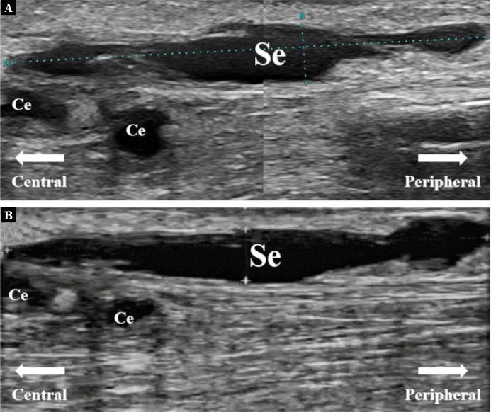 Seroma as a Rare Complication of Autologous Arteriovenous Fistula Creation in the Forearm of a Hemodialysis Patient: A Case Report.