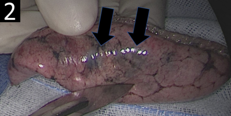 Insidious Onset of Pulmonary Langerhans Cell Histiocytosis During Oncological Follow-Up.