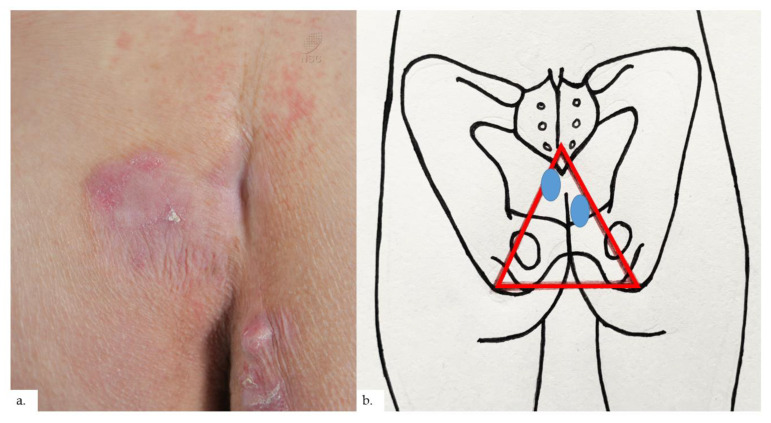 Reactive Epidermal Hyperplasia and Angiogenesis of the Rear (REAR): A Proposed Unifying Name for Senile Gluteal Dermatosis and Prurigiform Angiomatosis.