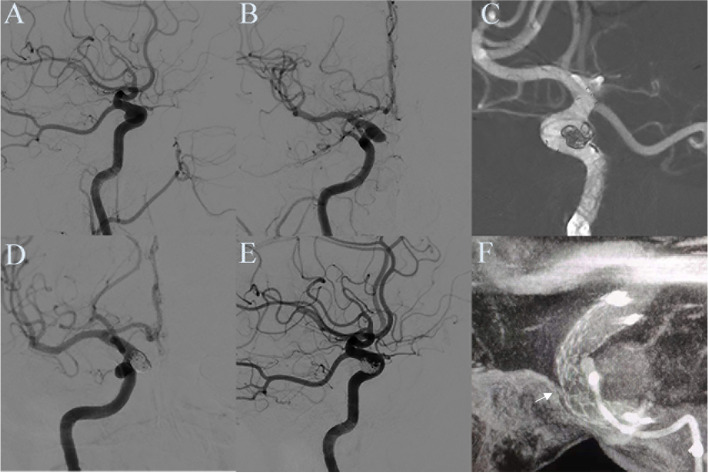 Effects of Enterprise 2 stent-assisted coil embolization for wide-necked intracranial aneurysms.