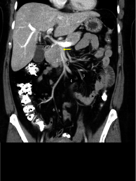 A Comparison of the Celiacomesenteric Trunk in the Caribbean with Global Prevalence Calculated by a Systematic Review.