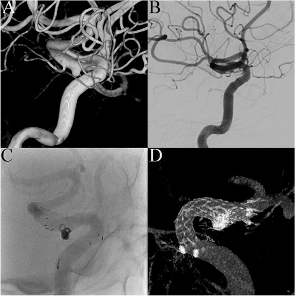 Effects of Enterprise 2 stent-assisted coil embolization for wide-necked intracranial aneurysms.