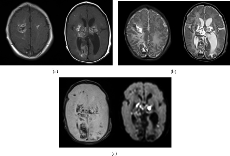 A Neonatal Patient Diagnosed with a <i>COL4A1</i> Mutation Presenting with Hemorrhagic Infarction and Severe Jaundice.