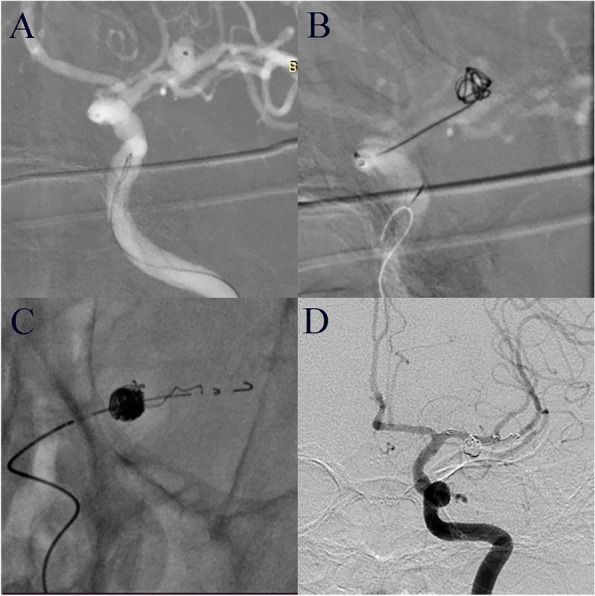 Effects of Enterprise 2 stent-assisted coil embolization for wide-necked intracranial aneurysms.