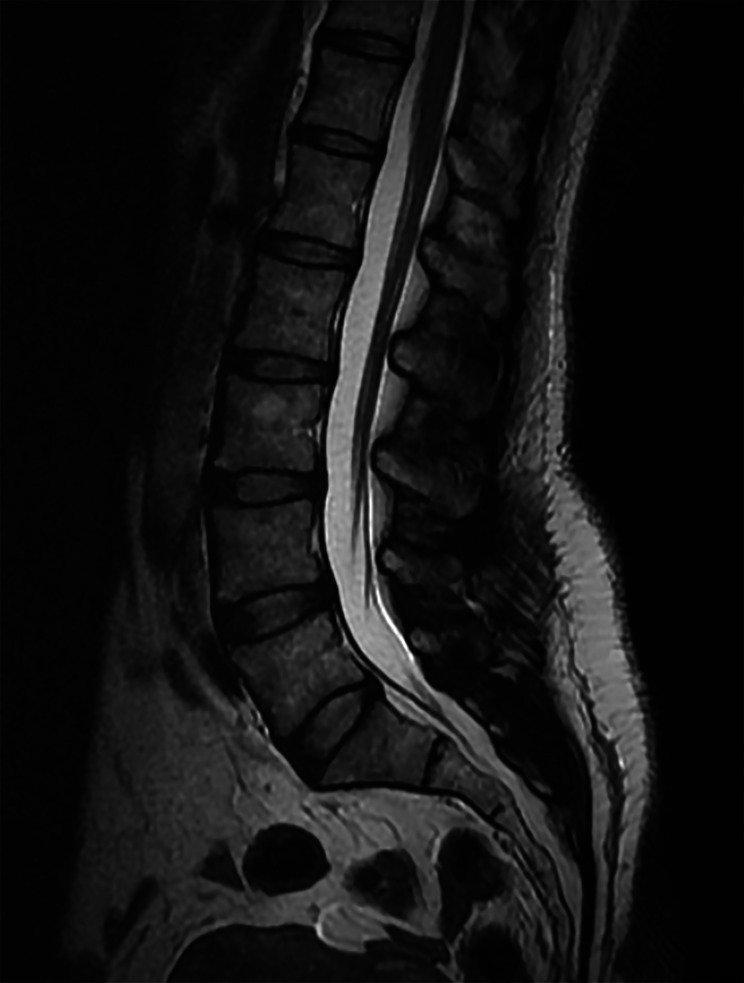 Ischial osteochondroma as an unusual source of pregnancy-related sciatic pain: a case report.