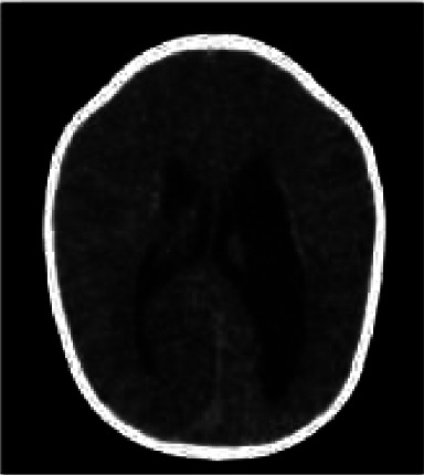 A Neonatal Patient Diagnosed with a <i>COL4A1</i> Mutation Presenting with Hemorrhagic Infarction and Severe Jaundice.