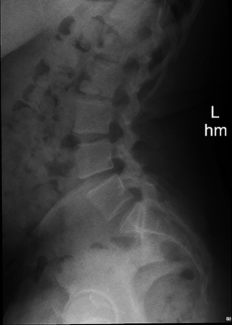 Ischial osteochondroma as an unusual source of pregnancy-related sciatic pain: a case report.