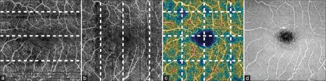 Pulsatile Ocular Blood Flow Registered with Optical Coherence Tomography Angiography in Patients with High Intraocular Pressure.