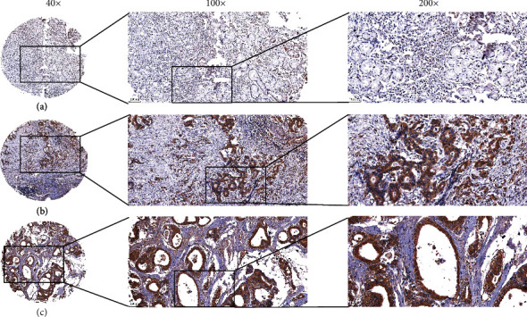 ZNF521 Is Correlated with Tumor Immune Cell Infiltration and Act as a Valuable Prognostic Biomarker in Gastric Cancer.