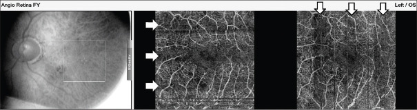 Pulsatile Ocular Blood Flow Registered with Optical Coherence Tomography Angiography in Patients with High Intraocular Pressure.